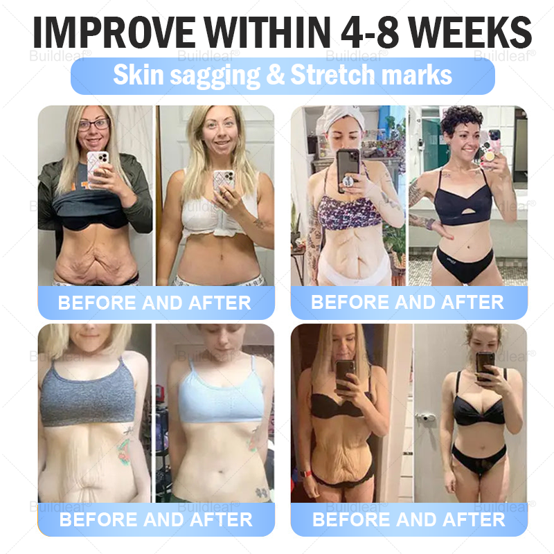 🚨 Hurry – 70% OFF Ends Soon! 🚨 Take control of your weight and health with 𝐵uil𝗱𝐿ea𝐟® GLP-1 Slim & Firm Nano Microneedle Patch. For obesity, metabolism, blood sugar and more — real results without painful injections.