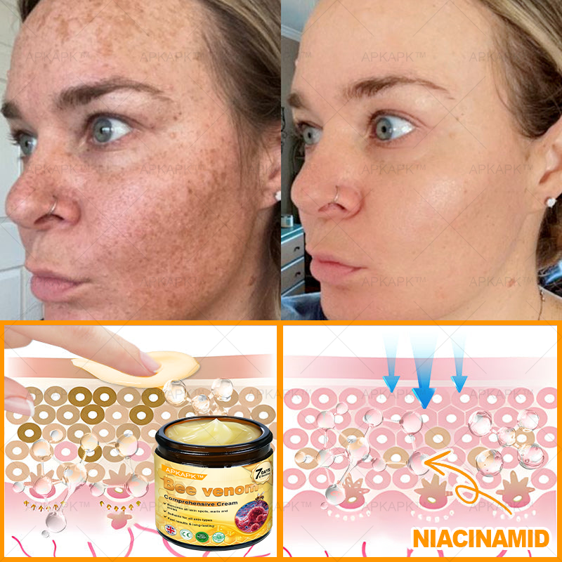 šāØ APKAPKĀ® Bee venom Comprehensive Cream š„ Sagging Skin, Fine Lines, Loss of Firmness, Flat Bust, Drooping Hips, and More