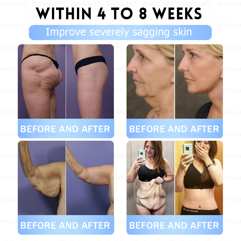 🚨 Hurry – 70% OFF Ends Soon! 🚨  Take control of your weight and health with 𝐵uil𝗱𝐿ea𝐟® GLP-1 Slim & Firm Nano Microneedle Patch. For obesity, metabolism, blood sugar and more — real results without painful injections.